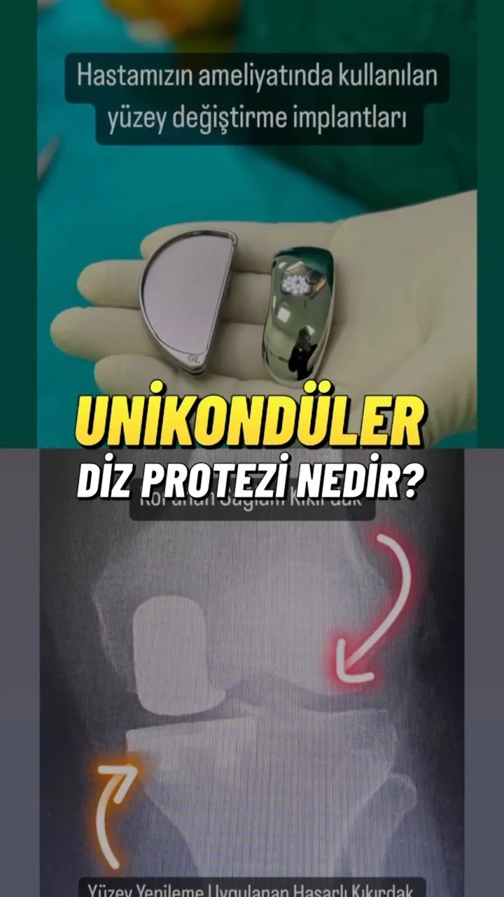 Unikondüler (kısmi) diz protezi nedir? — Prof. Dr. Mehmet Emin Şimşek videosu