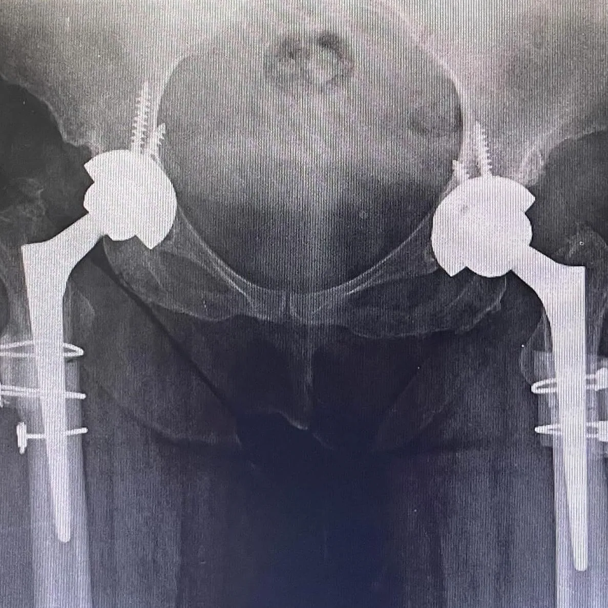 Her iki kalçaya kısaltma osteotomili total kalça protezi uygulanmış pelvis röntgeni