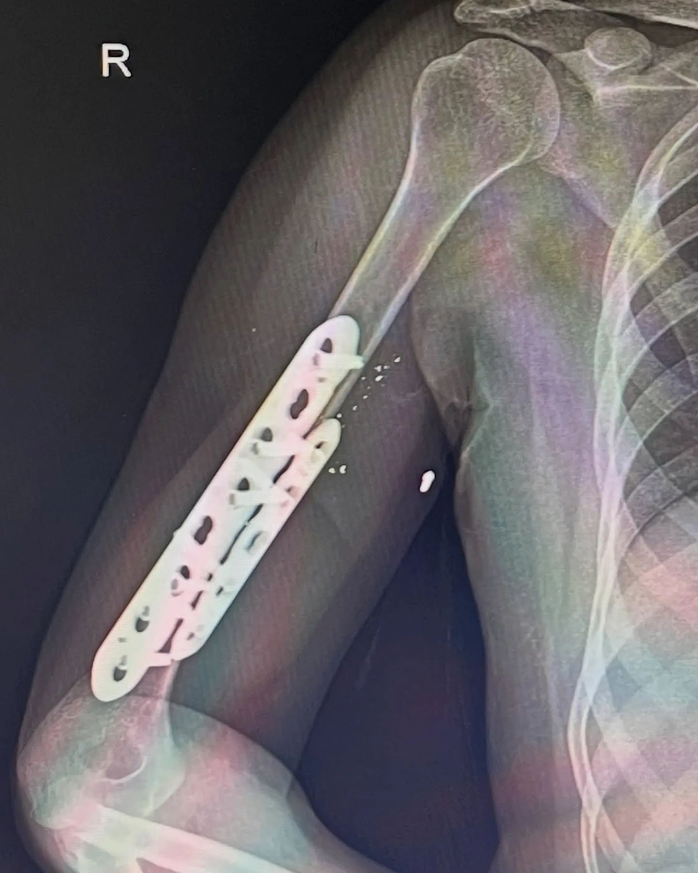 Humerus kırığının plak ve vidalarla tespit edildiğini gösteren sağ omuz ve kol röntgeni