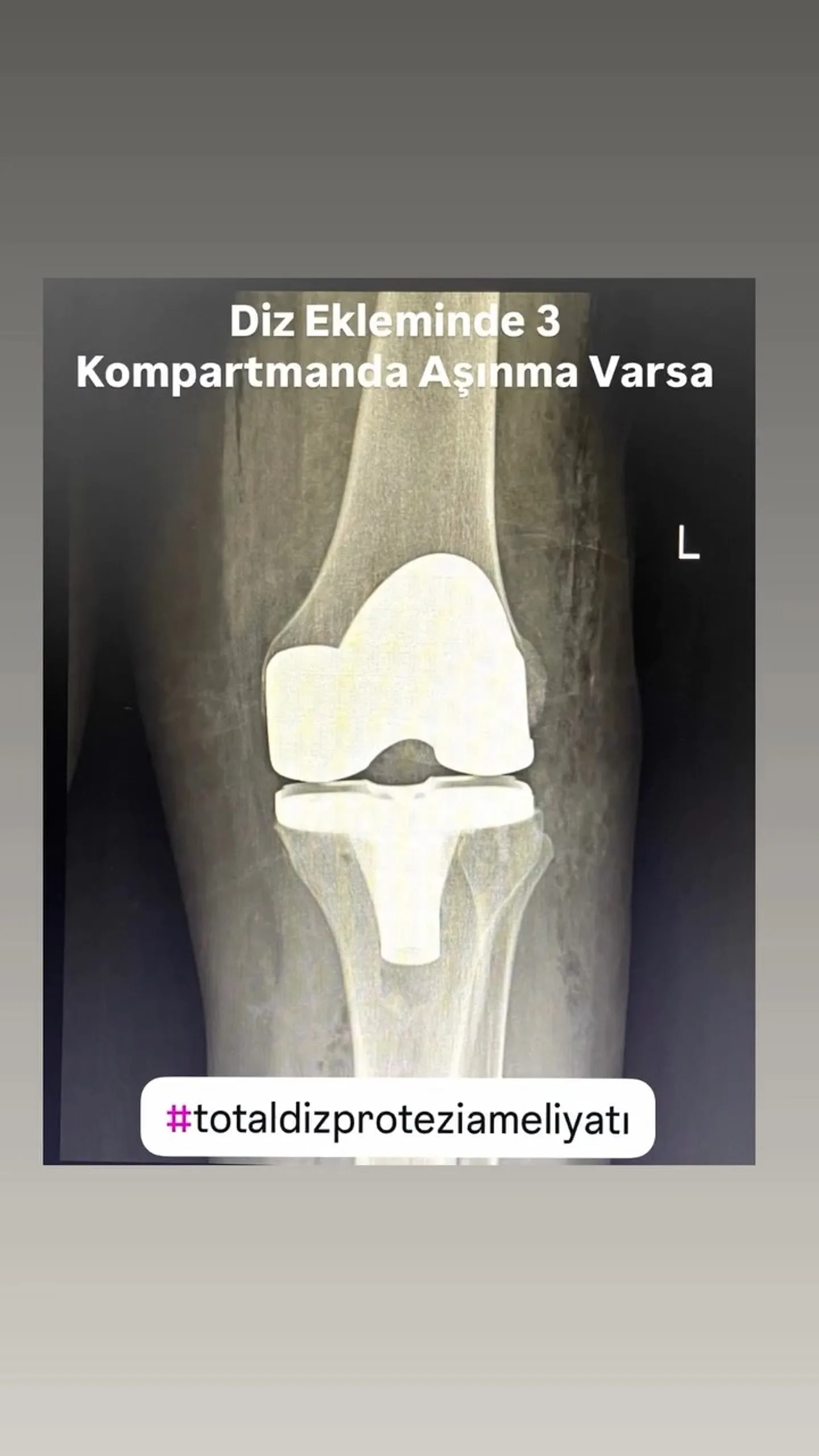 Total diz protezi uygulanmış dizin ön-arka röntgeninde implant bileşenlerinin görünümü