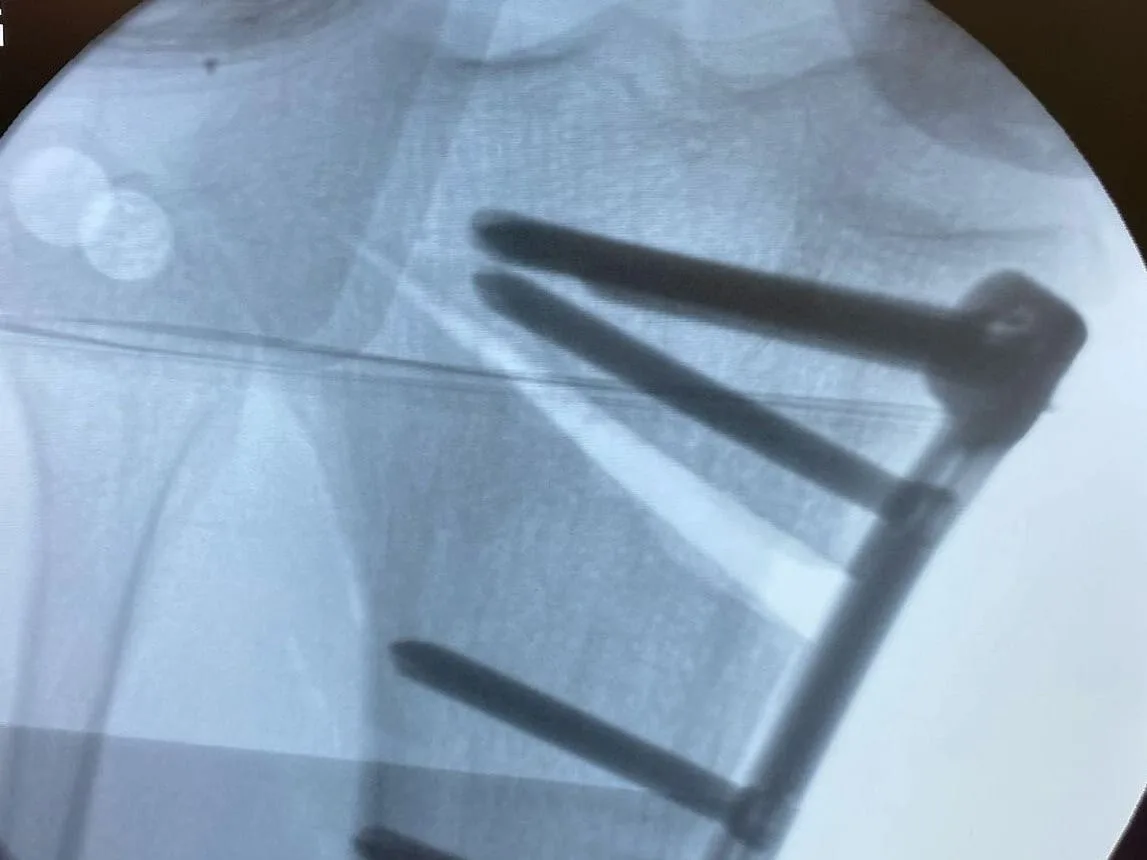 Yüksek tibial osteotomi sonrası plak ve vidaların görüldüğü ameliyat içi skopi görüntüsü