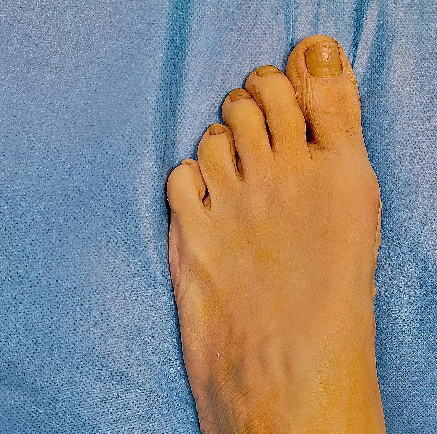 Halluks valgus cerrahisi sırasında ameliyathanede steril örtü üzerinde ayak.