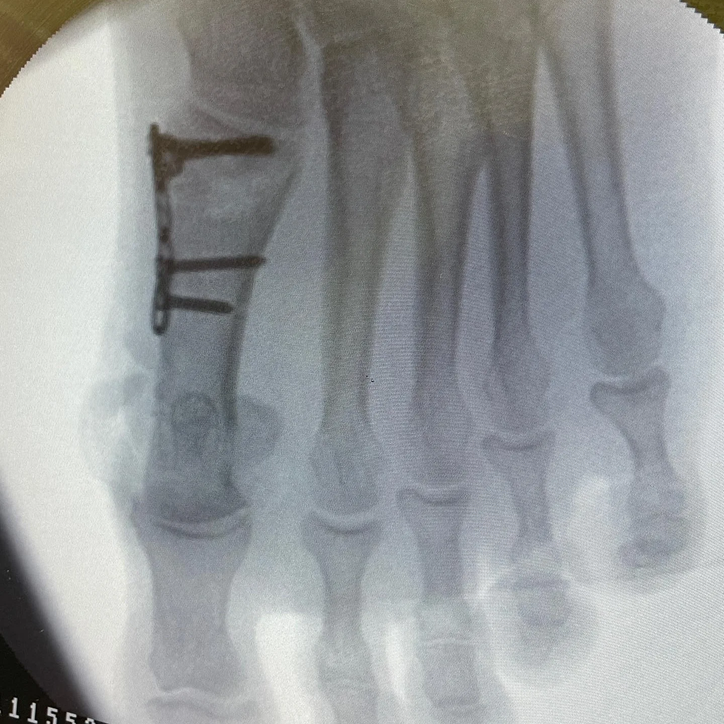 Ayak başparmağı osteotomisinin vidalarla tespitini gösteren ameliyat içi skopi görüntüsü.