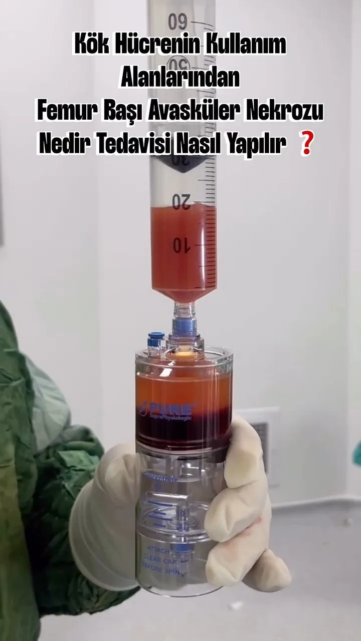 Femur başı avasküler nekrozu nedir, tedavisi nasıl yapılır? — Prof. Dr. Mehmet Emin Şimşek videosu