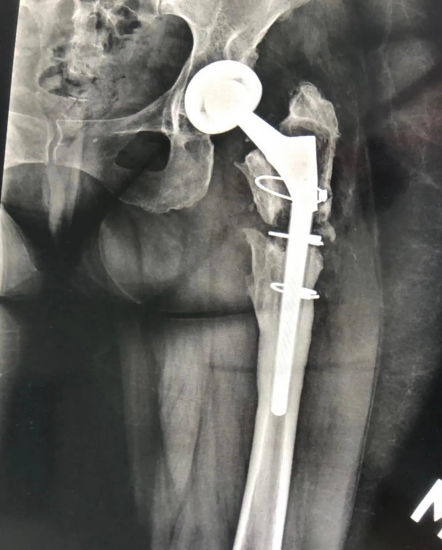 Kalça protezi revizyonu sonrası uzun saplı femoral komponent ve serklaj tellerini gösteren röntgen