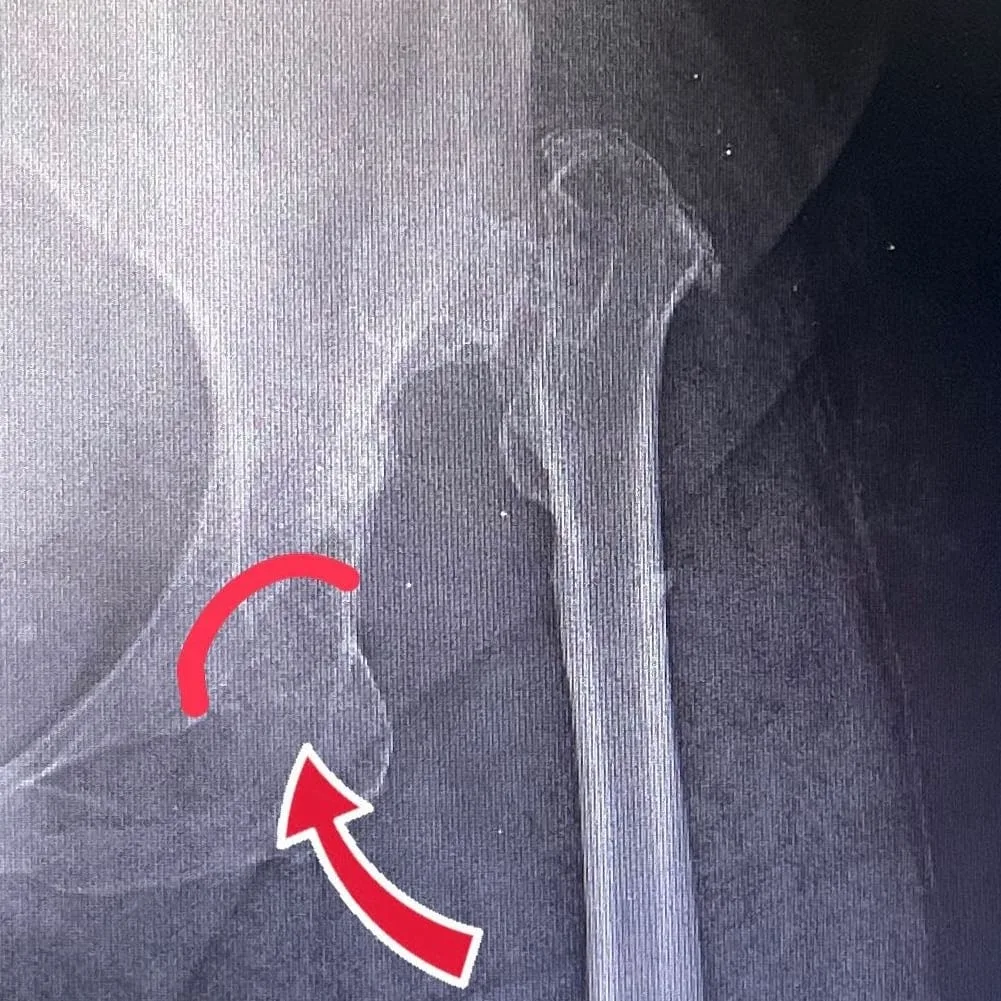 Kalça displazisinde femur başının gerçek asetabulum dışında konumlandığı röntgen