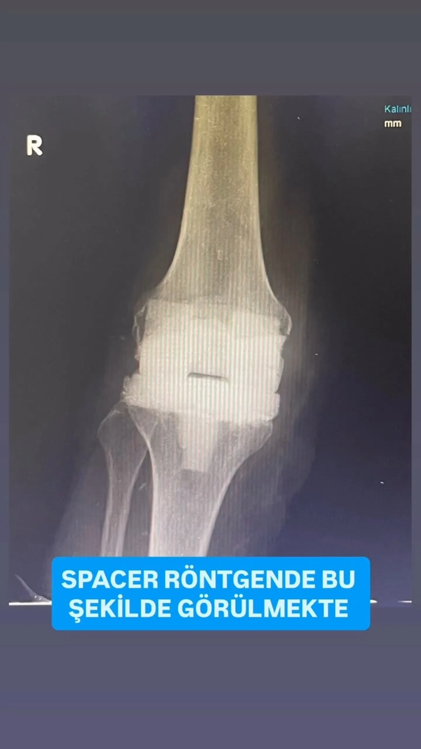 Diz protezi enfeksiyonunda uygulanan antibiyotikli spacerın ön-arka röntgen görünümü