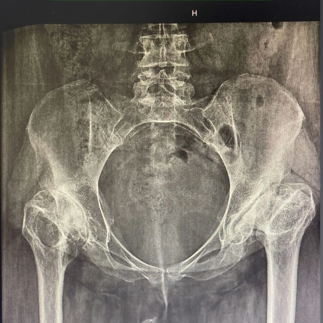 Her iki kalça ekleminde eklem aralığı daralmasının izlendiği ameliyat öncesi pelvis röntgeni