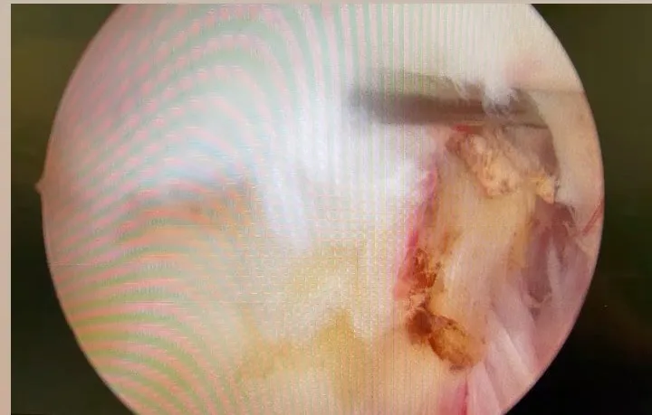 Omuz artroskopisinde üst labrum (SLAP) lezyonunun onarım öncesi görünümü.