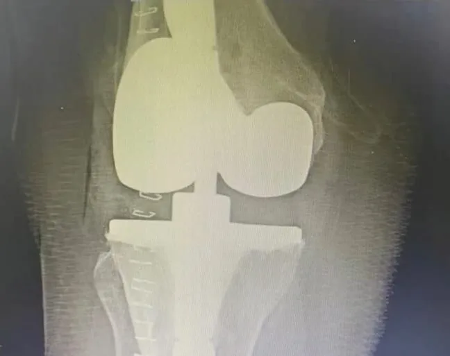 Revizyon diz protezi sonrası uzun saplı femoral ve tibial bileşenleri gösteren ön-arka grafi
