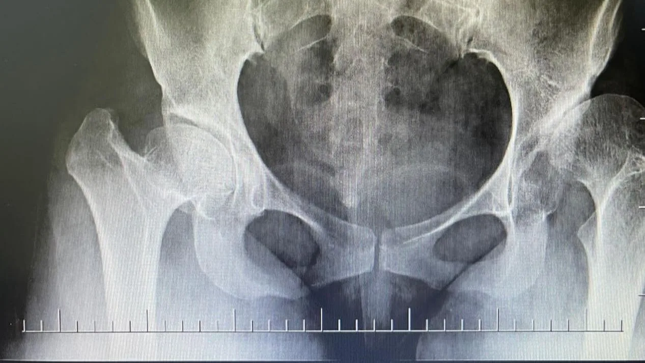 Her iki kalça ekleminde displazi izlenen, ameliyat öncesi çekilmiş pelvis ön arka röntgeni