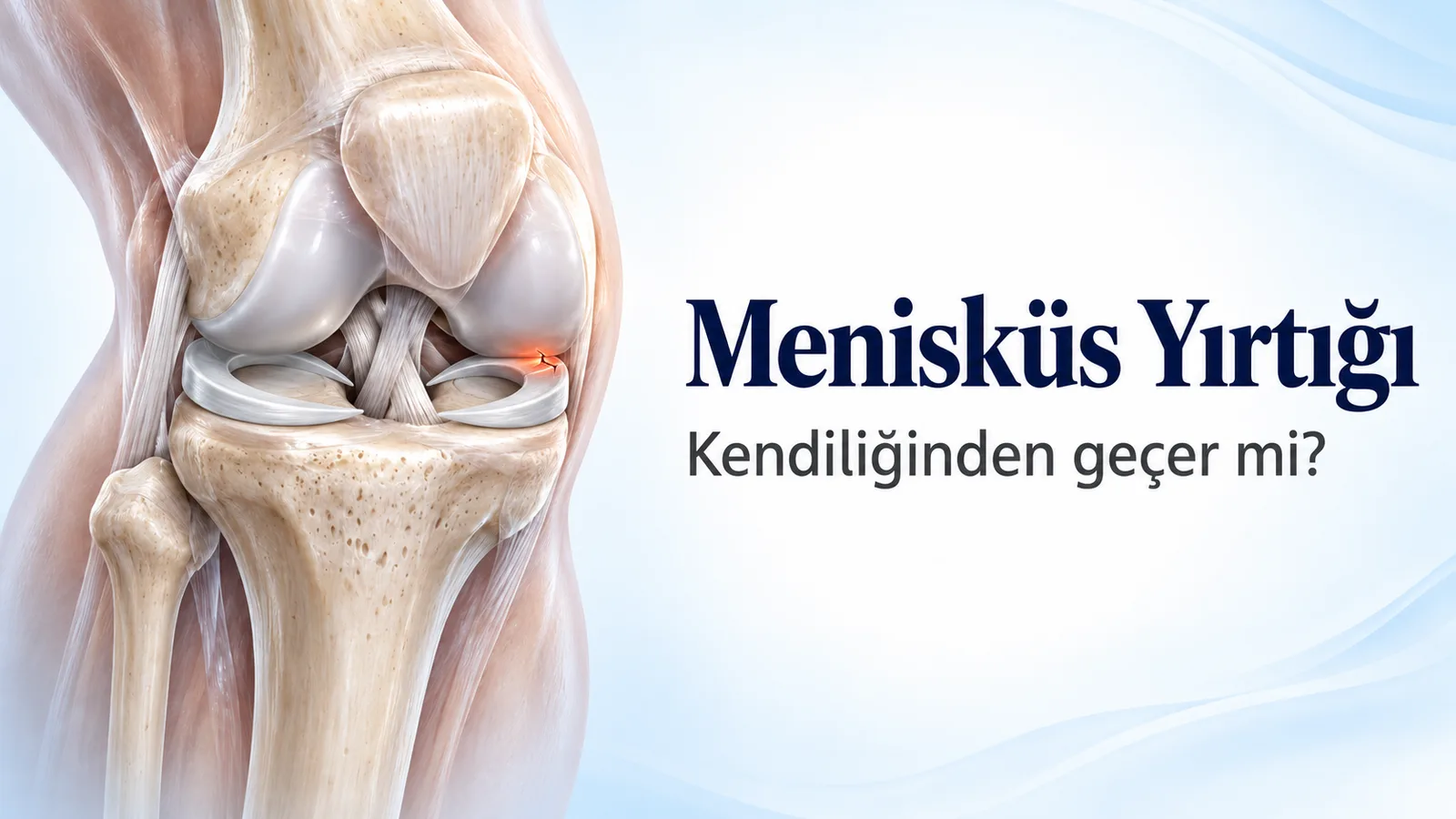 Menisküs yırtığı kendiliğinden geçer mi: önden görünen dizde kaval kemiğinin üstündeki iki menisküs ve iç menisküsün kenarında turuncu renkle işaretlenmiş küçük yırtık.