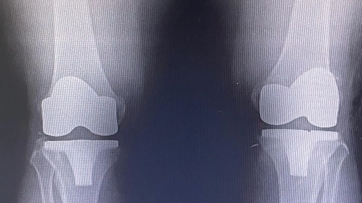 Her iki dizde total diz protezi uygulanmış ameliyat sonrası ön arka diz röntgeni