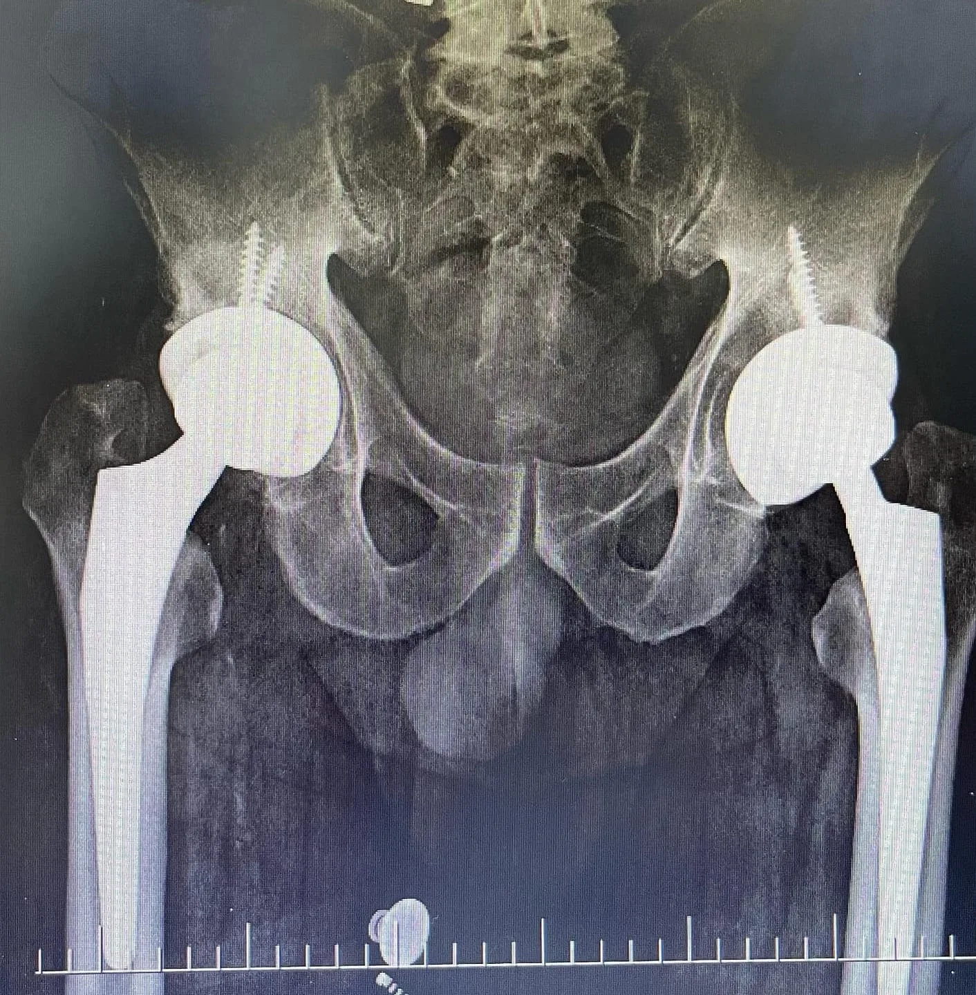 Her iki kalça ekleminde total protez uygulanmış hastanın ameliyat sonrası pelvis ön arka röntgeni