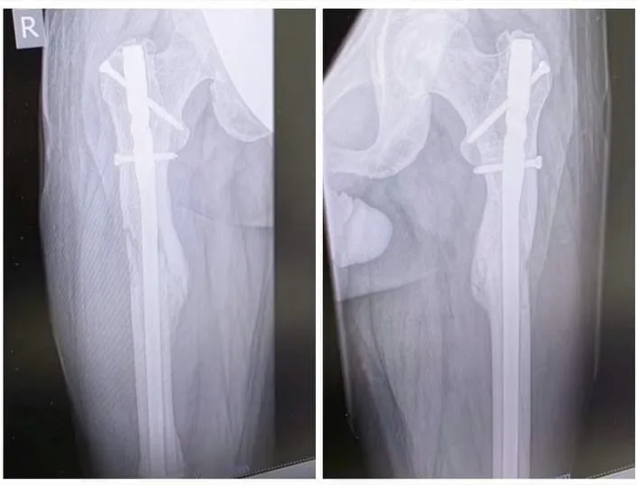 Femur içine yerleştirilen uzatma çivisiyle uzama sürecini gösteren iki karşılaştırmalı grafi