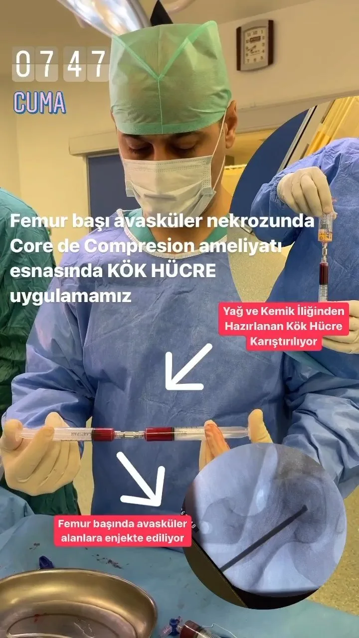 Femur başı avasküler nekrozunda kök hücre uygulaması — Prof. Dr. Mehmet Emin Şimşek videosu