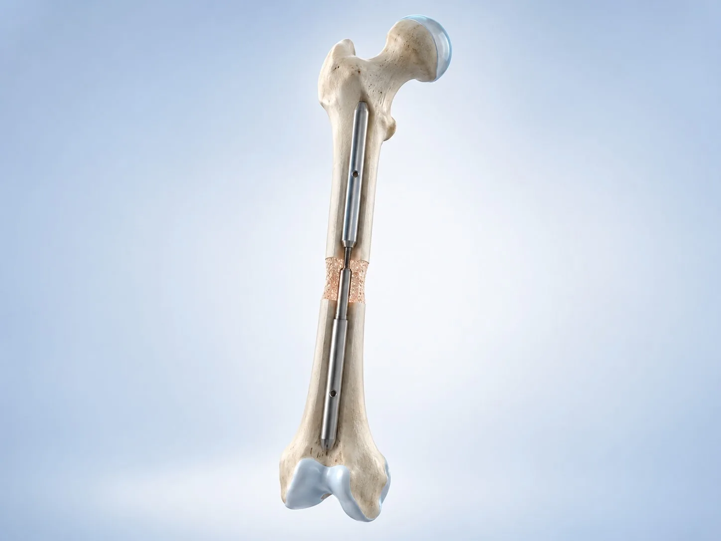 Uyluk kemiği içine yerleştirilmiş uzatma çivisini gösteren üç boyutlu anatomik illüstrasyon.