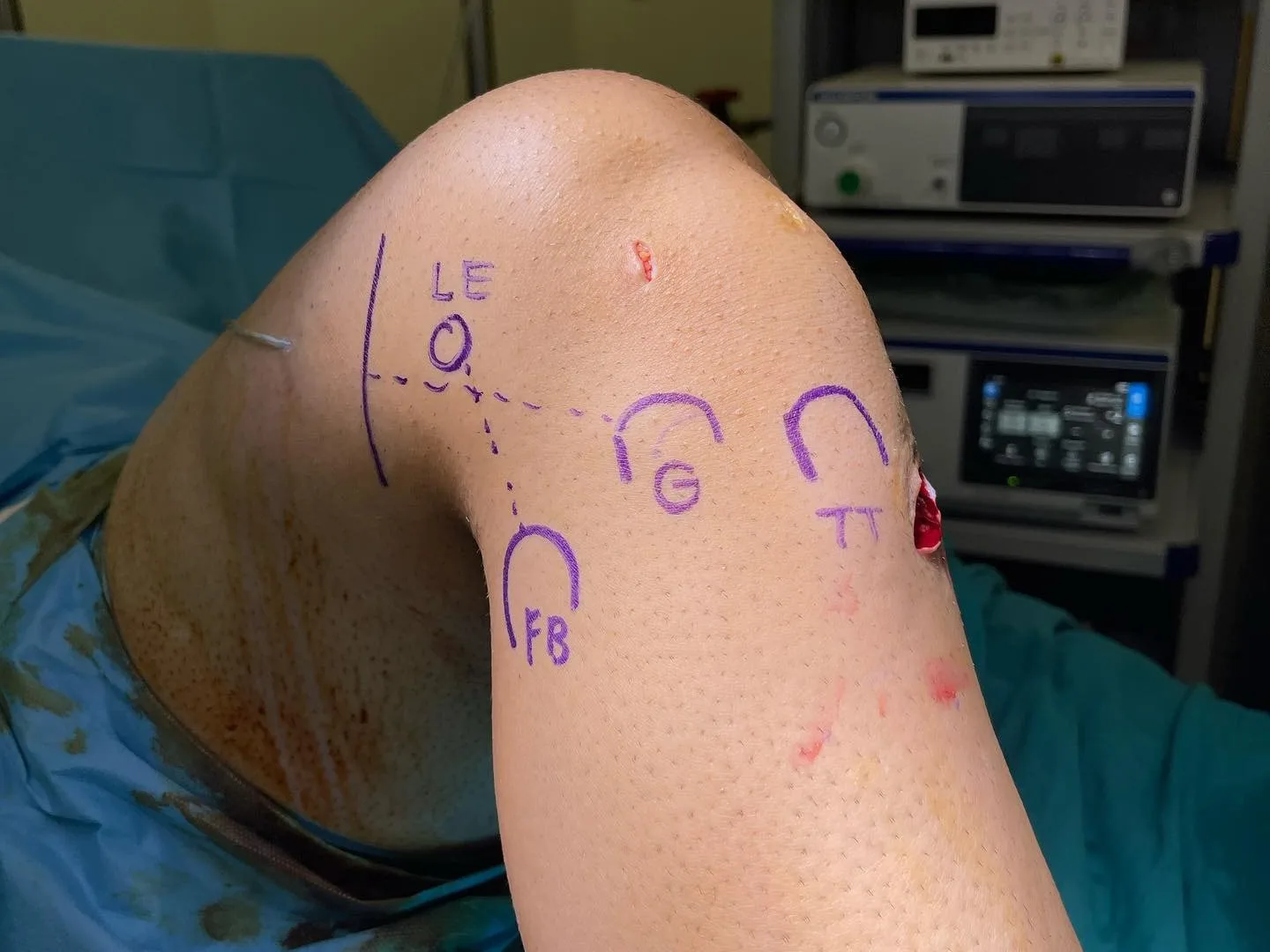 Diz bağ cerrahisi öncesi dizde anatomik noktaların cilt üzerine işaretlenmesi.