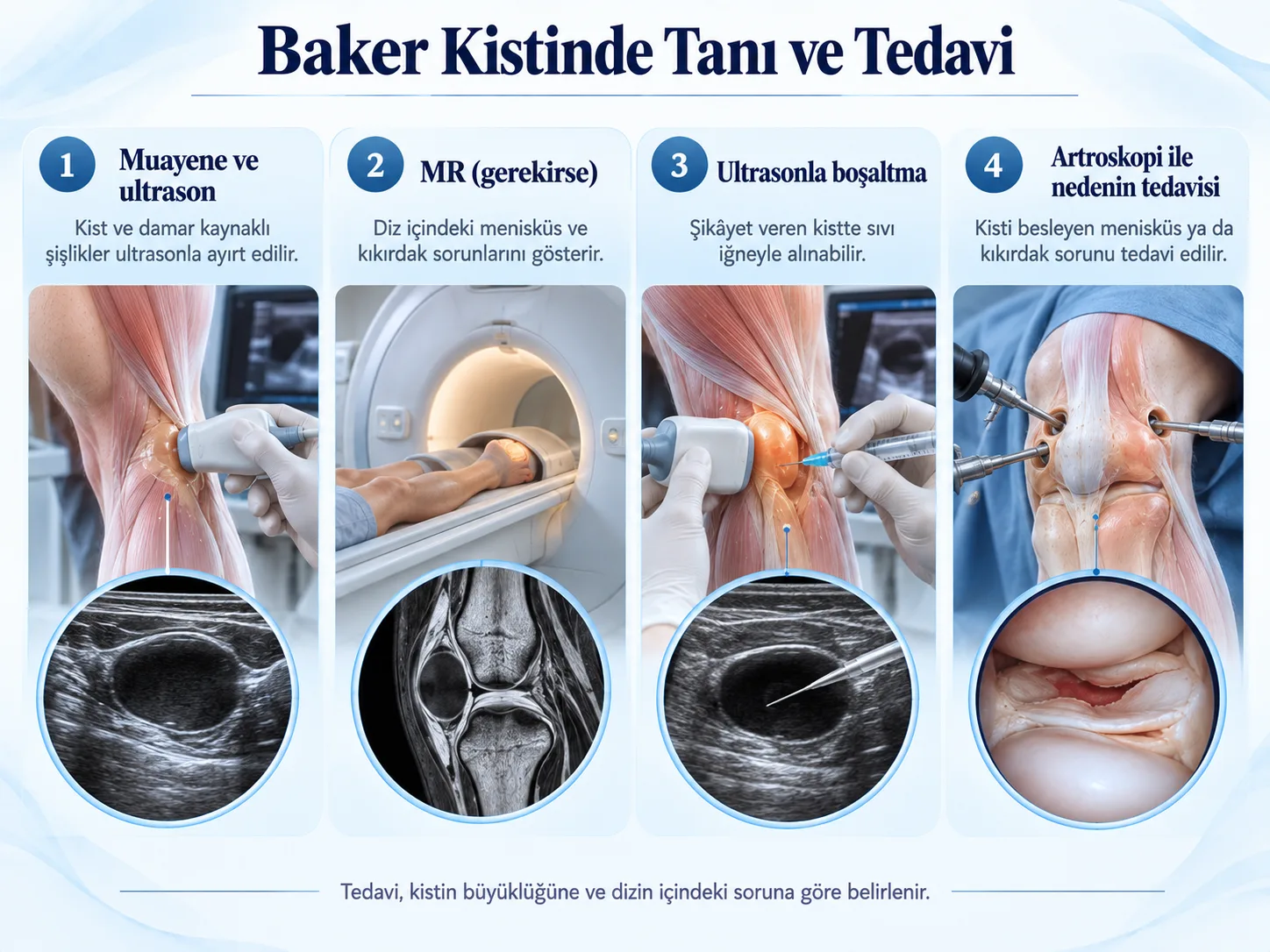 Baker kistinde tanı ve tedavi: ultrason, MR, ultrason eşliğinde boşaltma ve artroskopi ile nedenin tedavisi