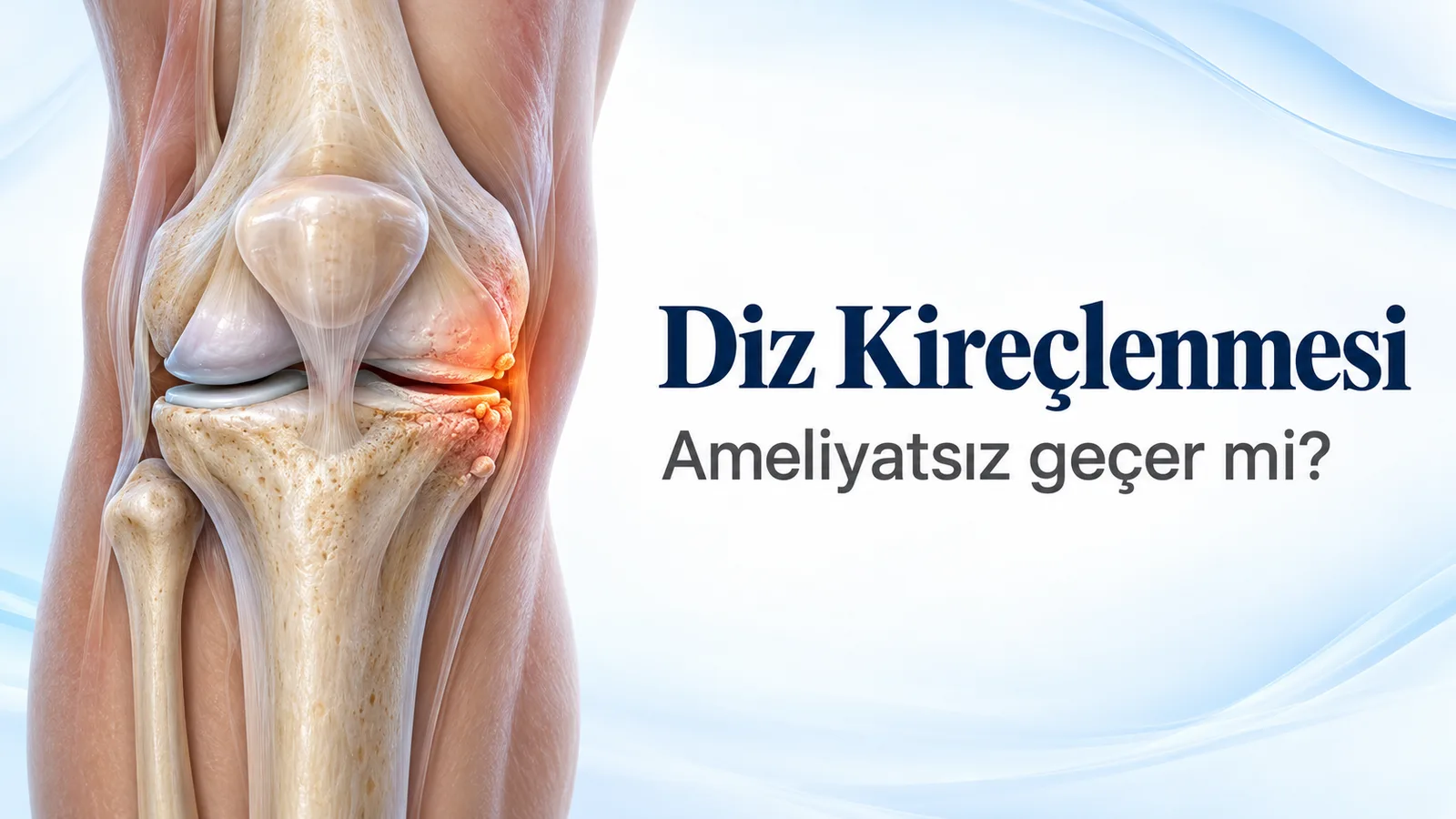 Diz kireçlenmesi ameliyatsız geçer mi: önden görünen dizin iç tarafında incelmiş kıkırdak, daralmış eklem aralığı ve turuncu renkle işaretlenmiş kemik çıkıntıları.