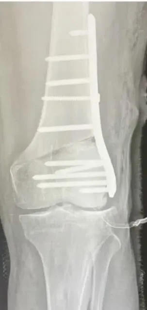 Distal femoral osteotomi sonrası plak ve vidalarla tespit edilmiş diz bölgesinin röntgeni