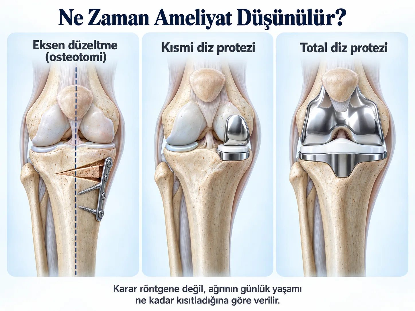Diz kireçlenmesinde ne zaman ameliyat düşünülür: eksen düzeltme (osteotomi), kısmi diz protezi ve total diz protezi. Karar röntgene değil, ağrının günlük yaşamı ne kadar kısıtladığına göre verilir.