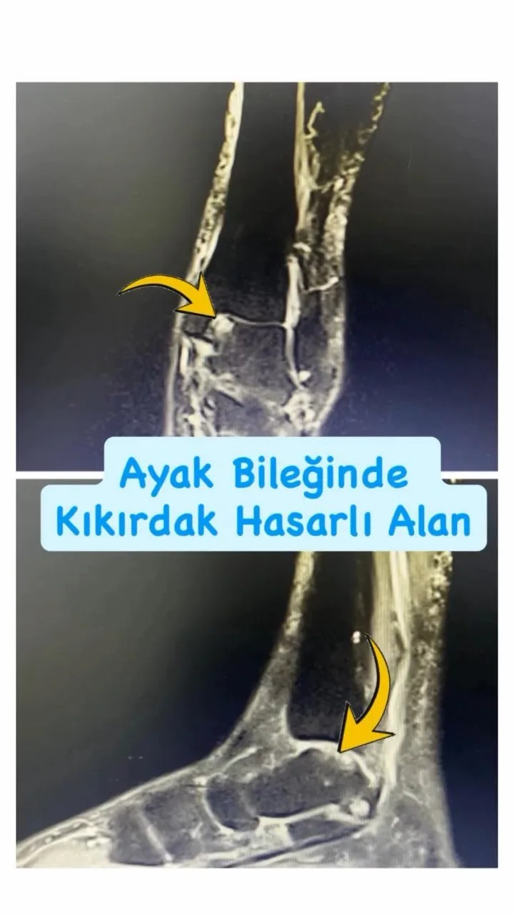 Ayak bileğinde küçük kıkırdak hasarlarının cerrahi tedavisi — Prof. Dr. Mehmet Emin Şimşek videosu