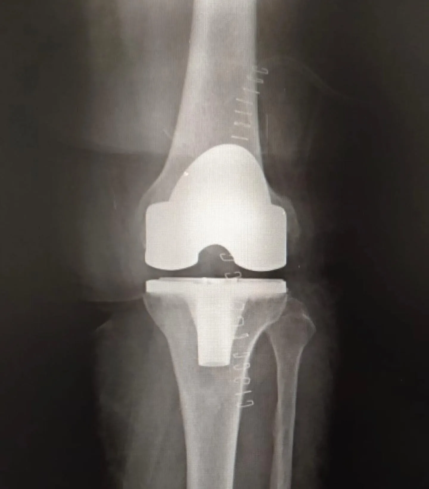 Total diz protezi uygulanmış dizin ön arka röntgeninde femoral ve tibial bileşenler