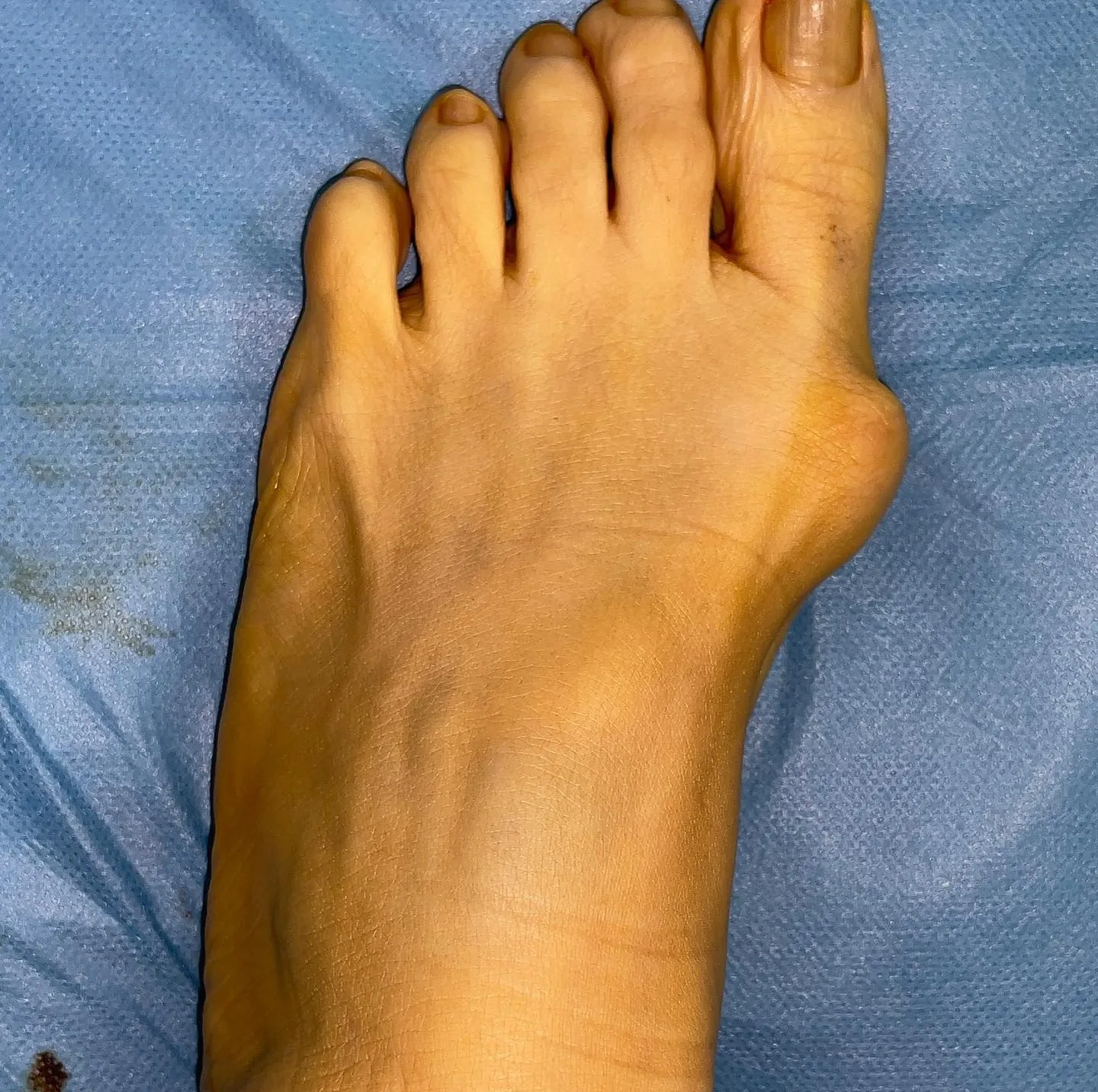 Ameliyathanede steril örtü üzerinde, başparmağı dışa açılanmış (halluks valgus) ayak.