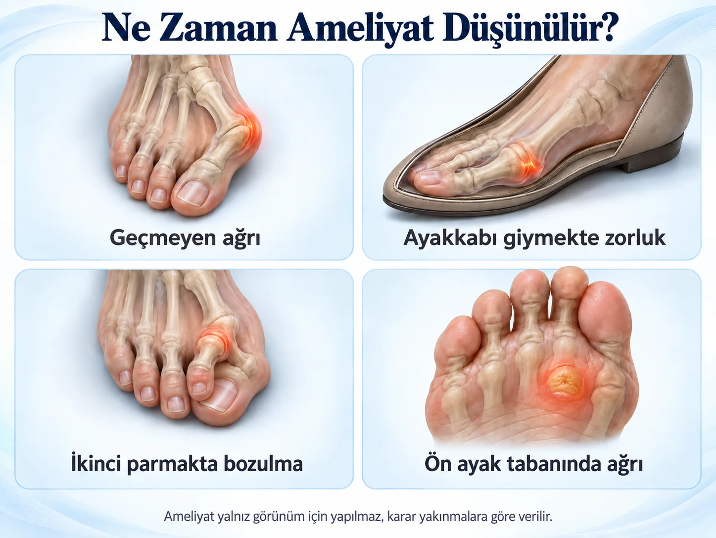 Halluks valgusta ameliyatın düşünüldüğü dört durum: geçmeyen ağrı, ayakkabı giymekte zorluk, ikinci parmakta bozulma ve ön ayak tabanında ağrı.