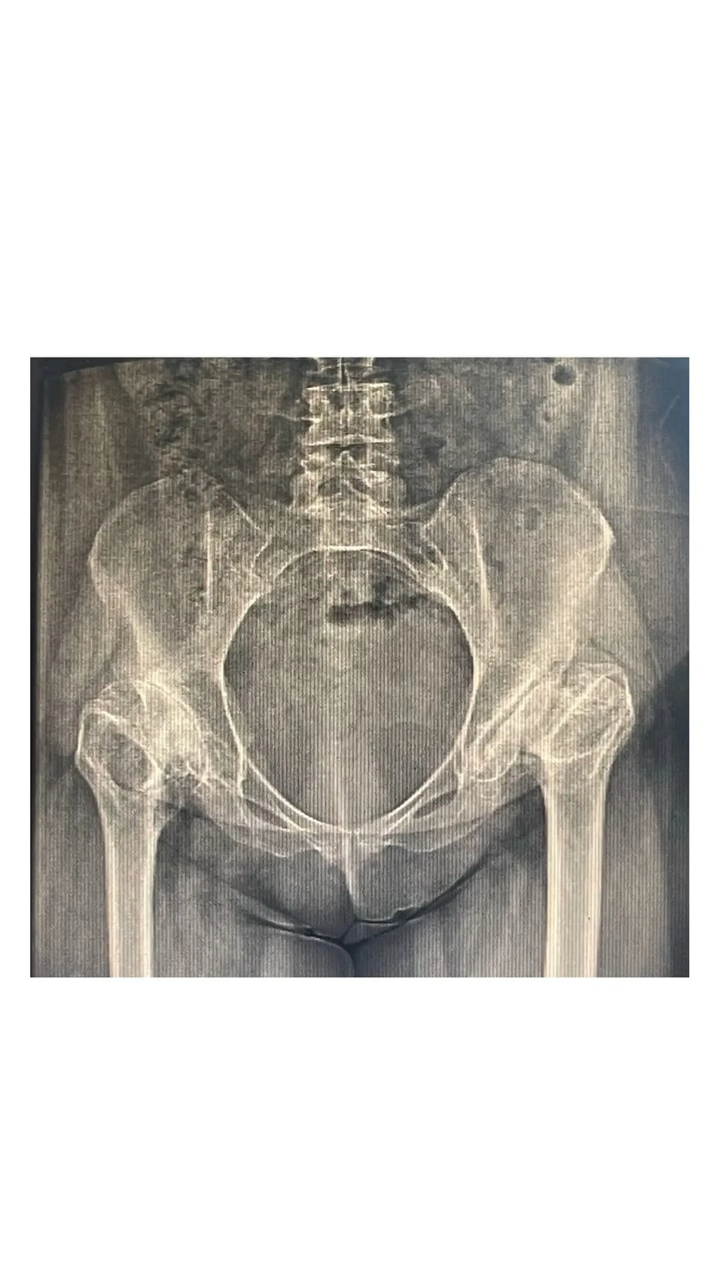Kalça protezi öncesi çekilmiş, her iki kalça eklemini gösteren pelvis röntgeni