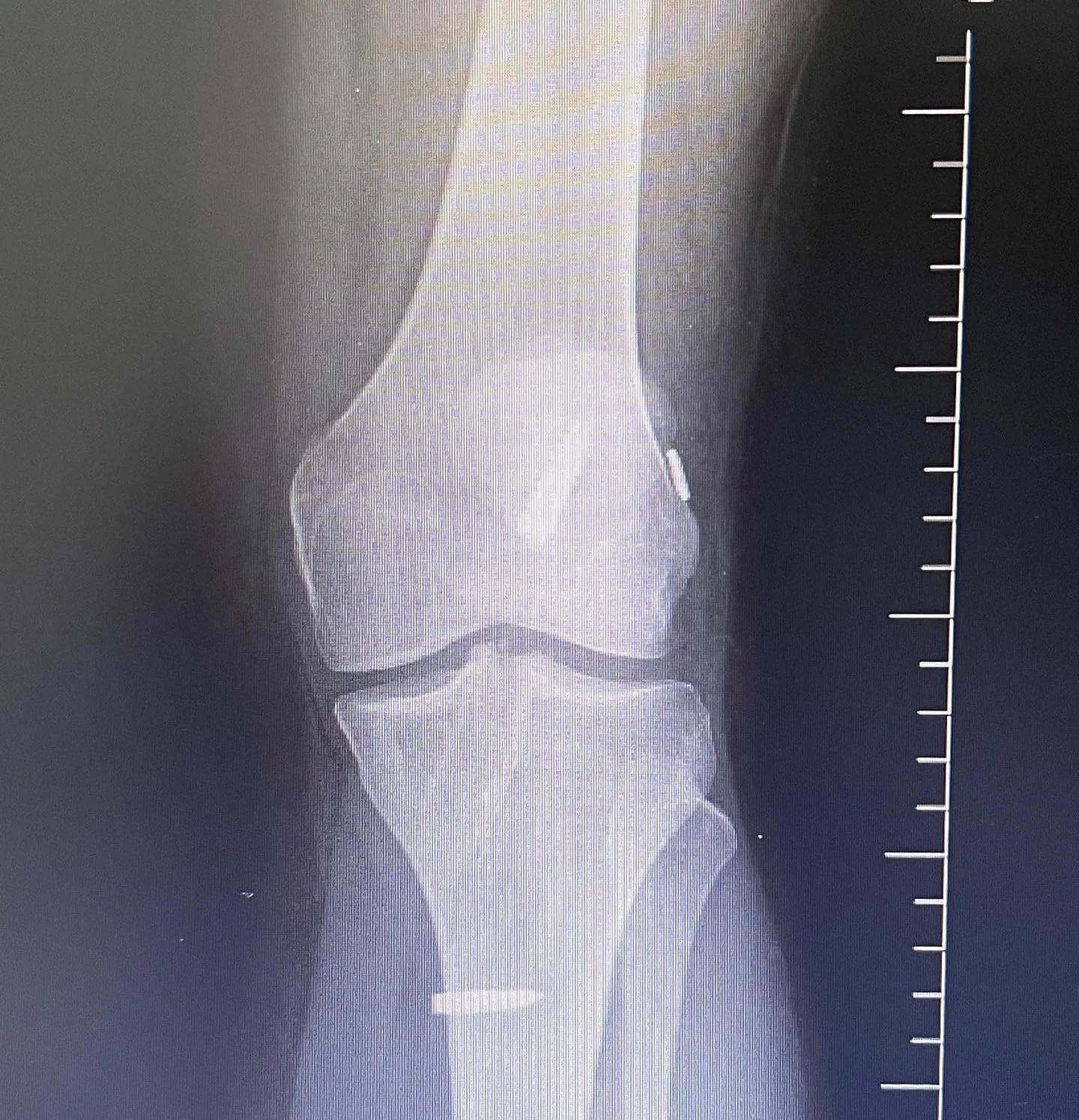 Diz ekleminin ön-arka röntgeninde femur ve tibia eklem yüzeylerinin görünümü