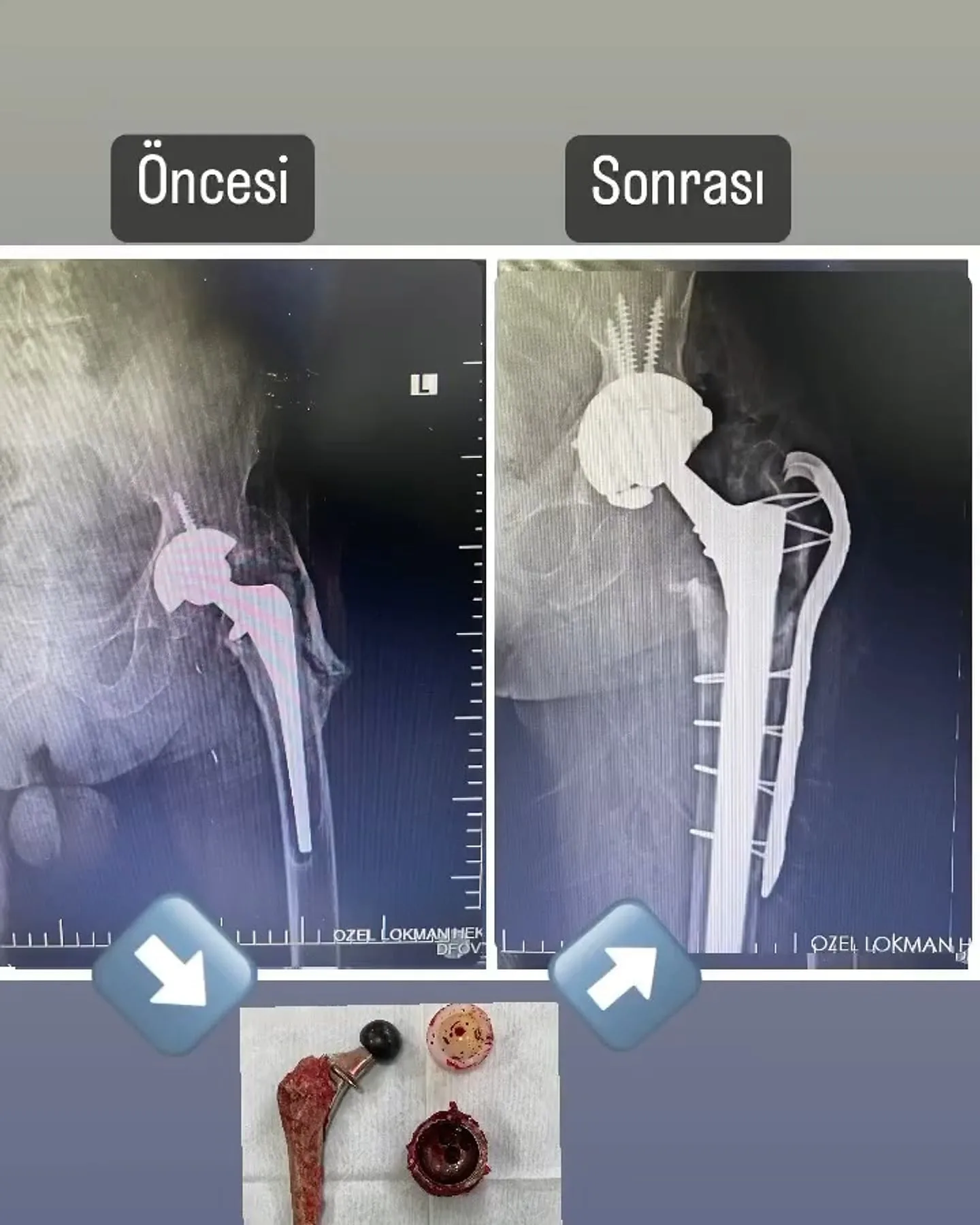 Kalça protezi gevşemesi öncesi ve revizyon sonrası karşılaştırmalı kalça röntgenleri