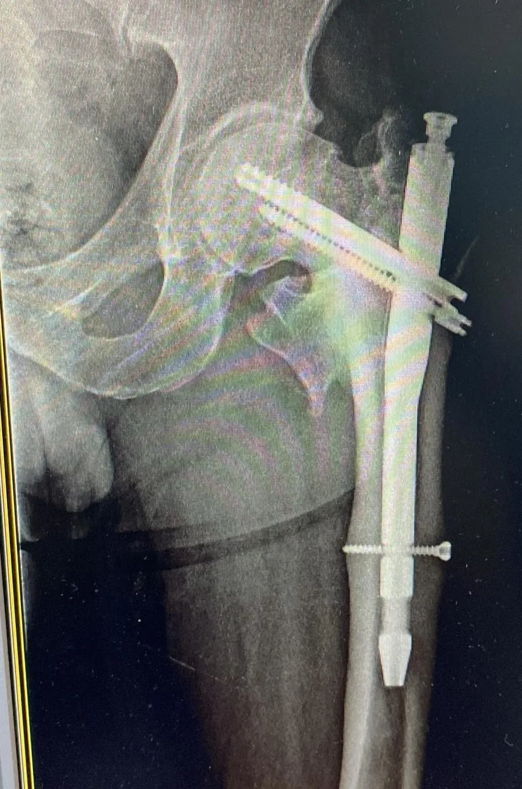 Kalça kırığında proksimal femur çivisi ve kilit vidalarıyla yapılan tespitin röntgen görünümü