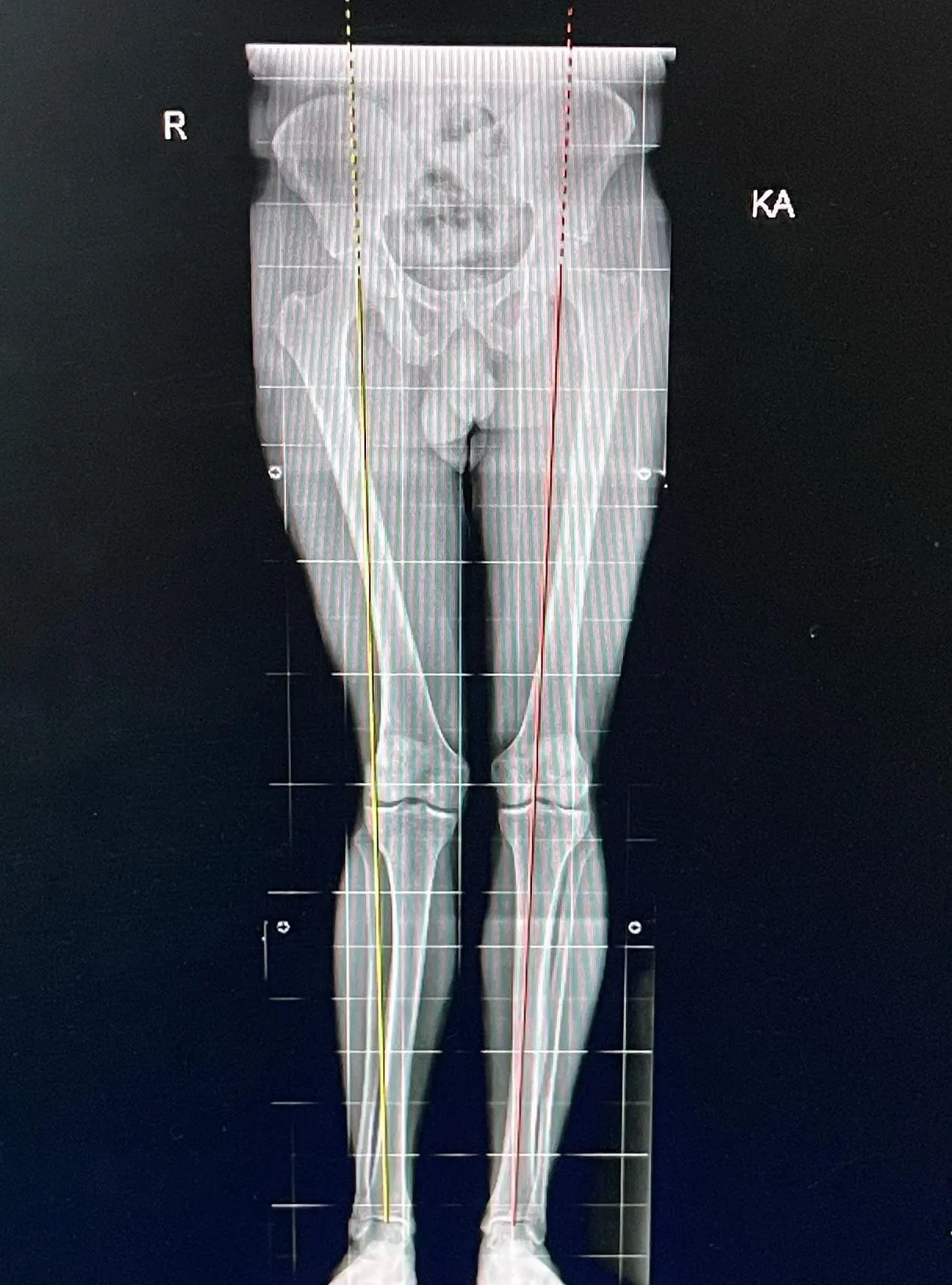 Alt ekstremite ortoröntgenogramında her iki bacağın mekanik eksen çizgileriyle değerlendirilmesi