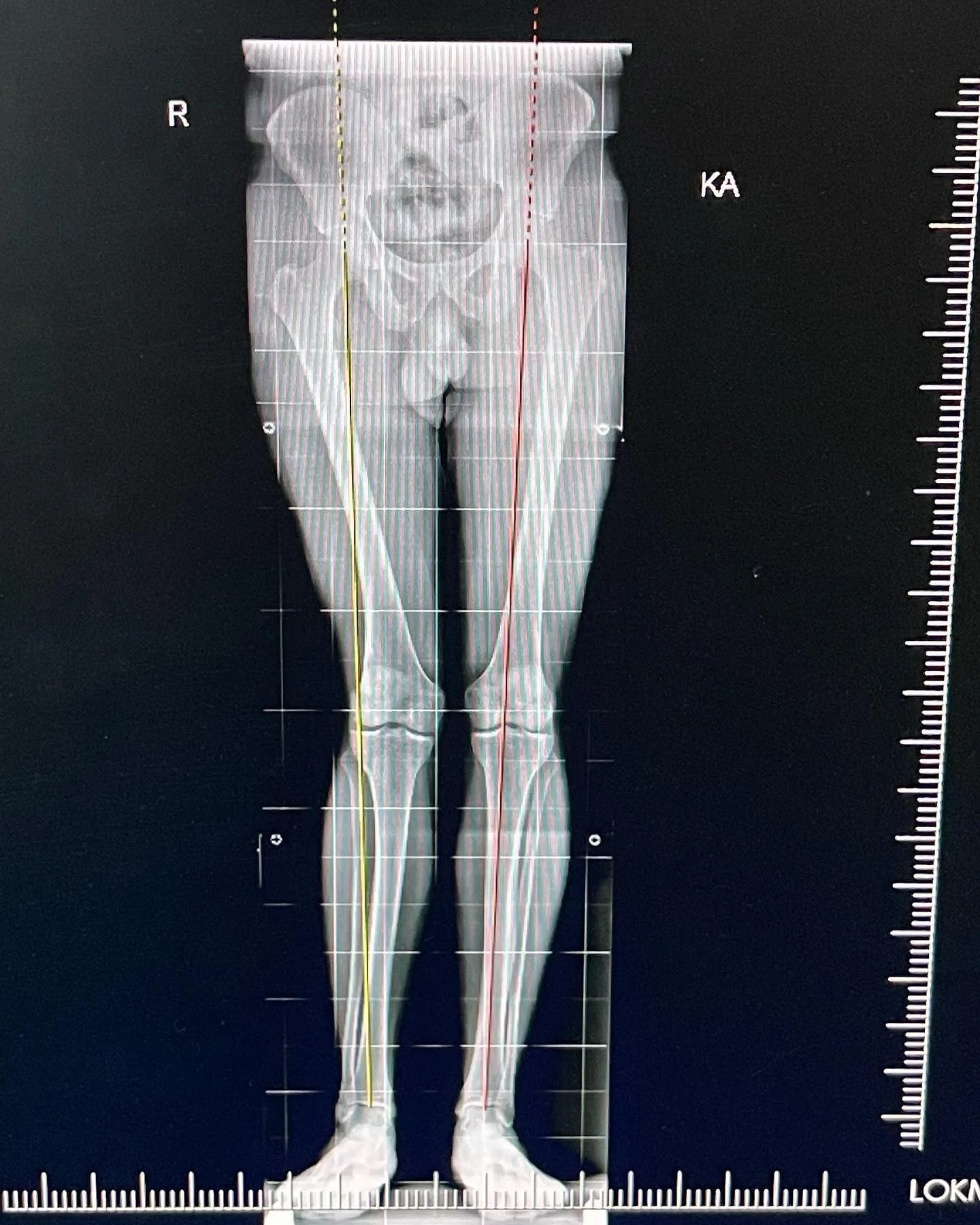 Her iki bacağın kalçadan ayak bileğine mekanik eksen çizgileriyle ortoröntgenogramı.